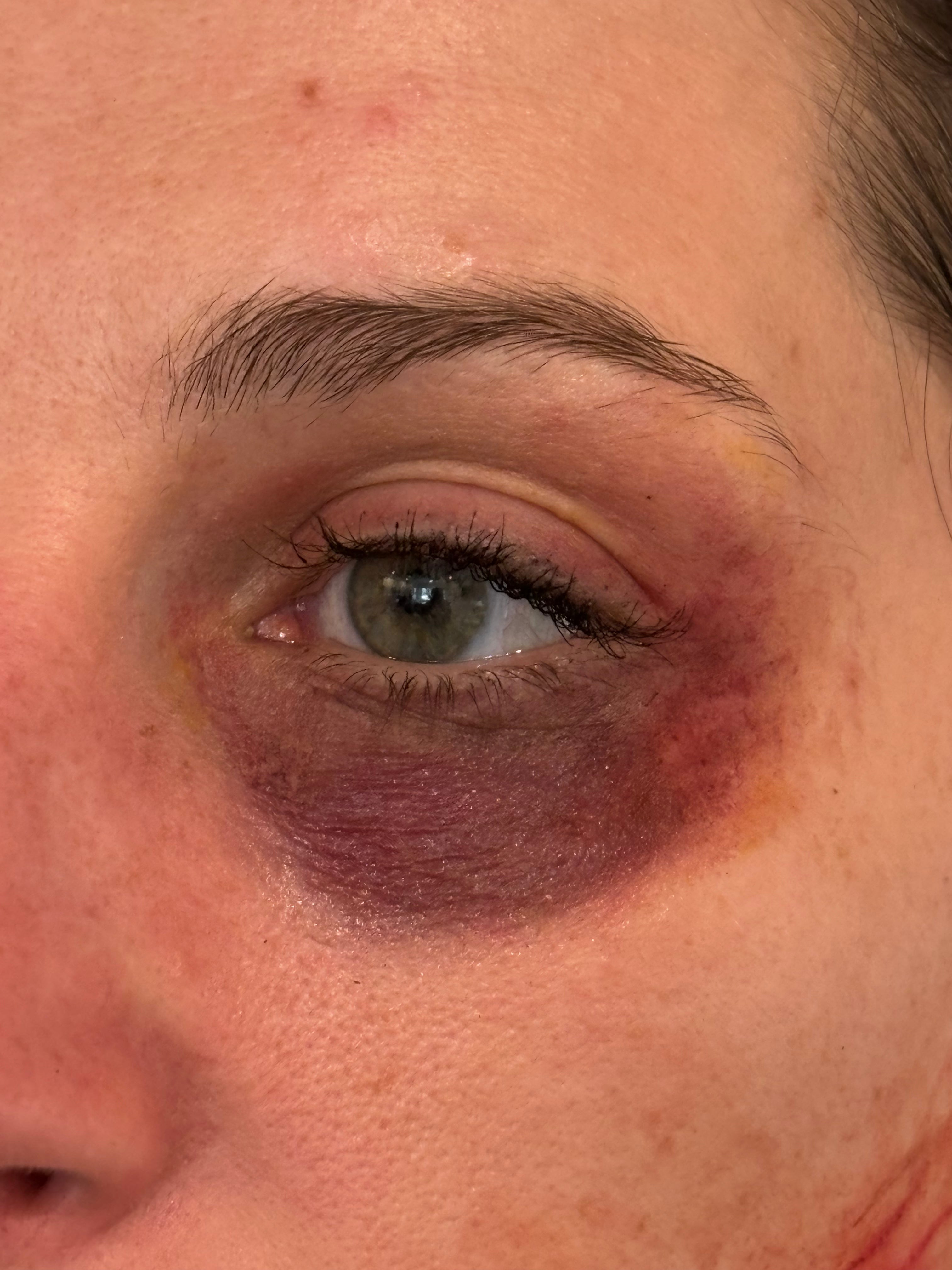 Realistic Bruise Temporary Tattoos